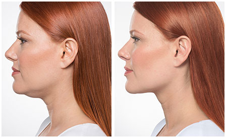 kybella double chin treatment before and after